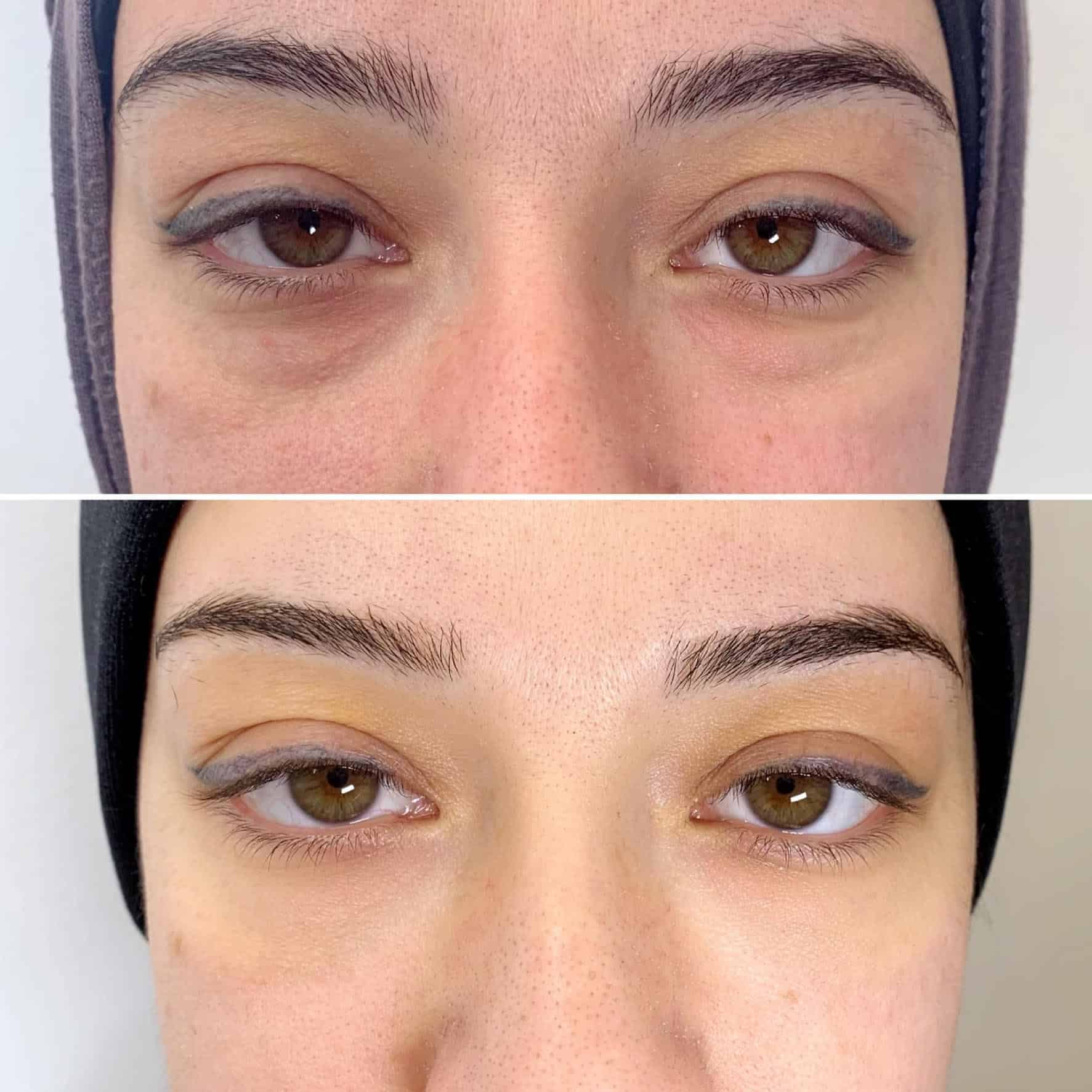 Tear Trough Before and After by Emel Kucuk