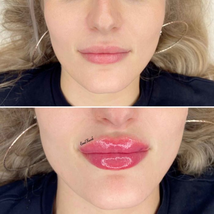 Lip Filler Before and After by Emel Kucuk