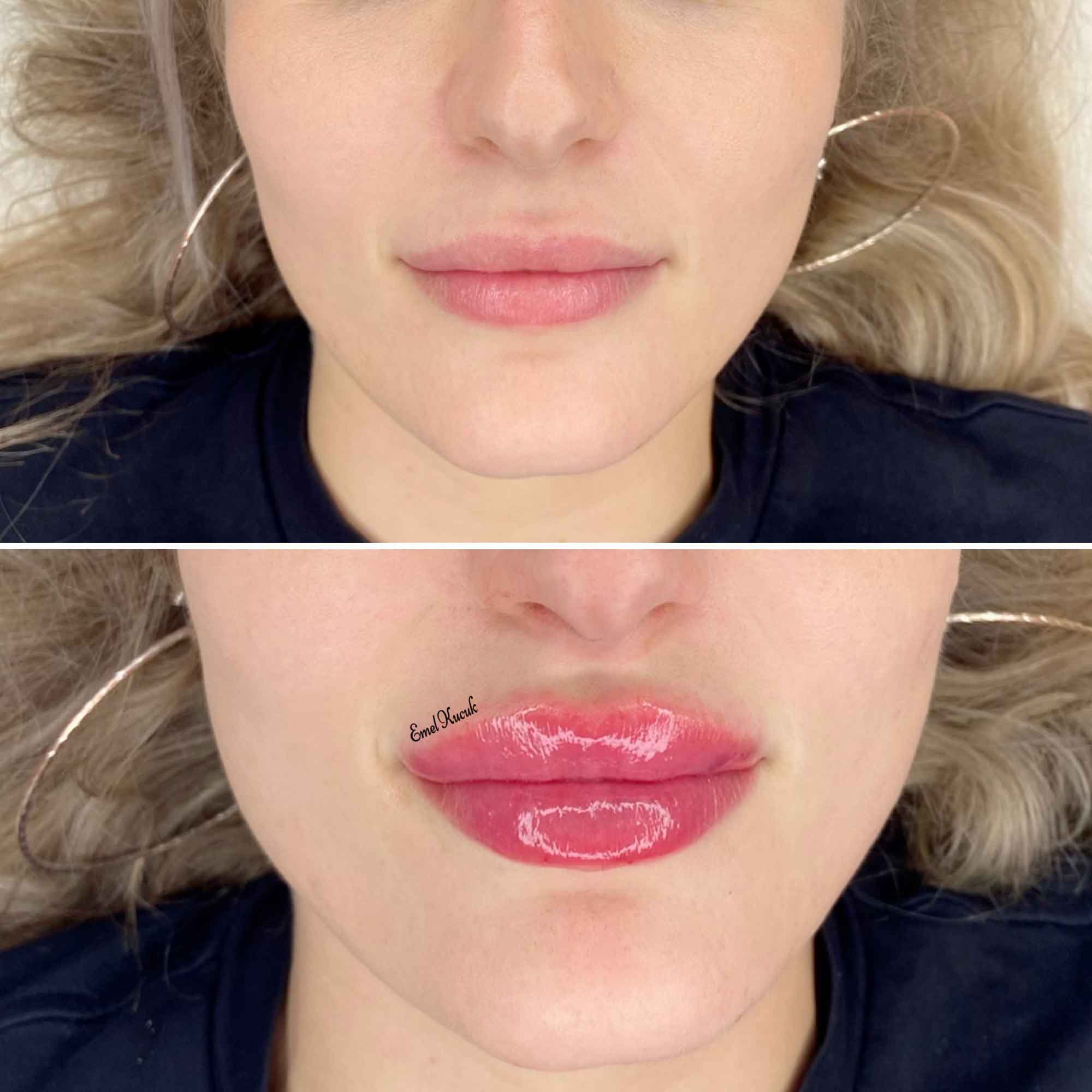 Lip Filler By North London Aesthetic Cosmetician Emel Kucuk 1ml 45mins