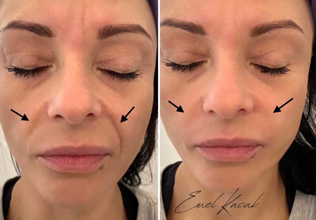 Chin Filler by North London Aesthetic Cosmetician Emel Kucuk