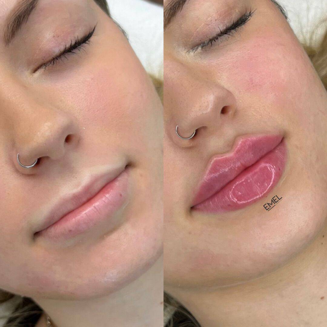 lip fillers