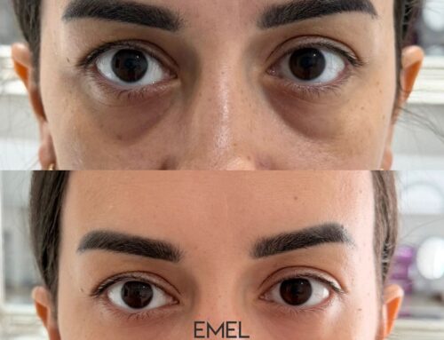 Discover the Benefits of Tear Trough Fillers: A Comprehensive Guide
