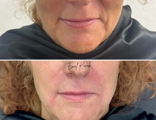 Nasolabial Folds: Filler Duration, Pain Levels & Botox vs Filler Guide | Emel Kucuk